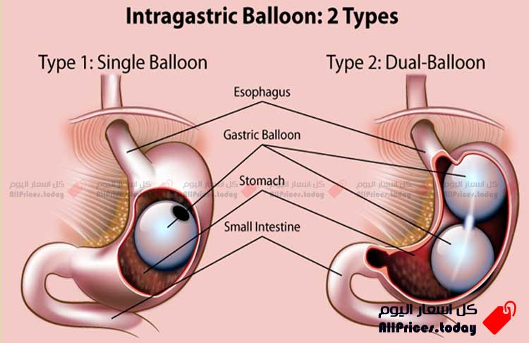 كيفية إجراء عملية بالون المعدة