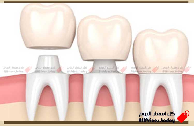 أسعار تلبيس الاسنان في جدة