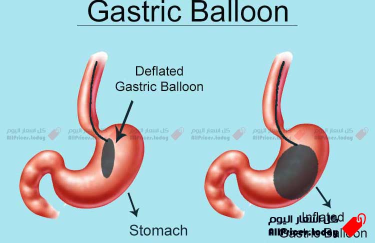 ارخص سعر لعملية بالون المعدة ، اسعار بالون المعدة في السعودية 2022